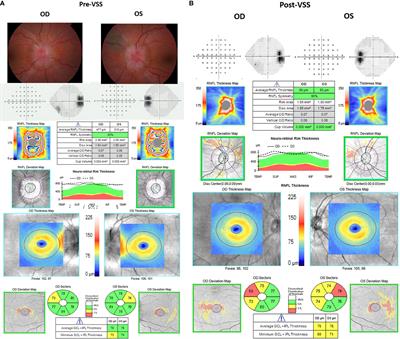 Improved Ophthalmic Outcomes Following Venous Sinus Stenting in Idiopathic Intracranial Hypertension